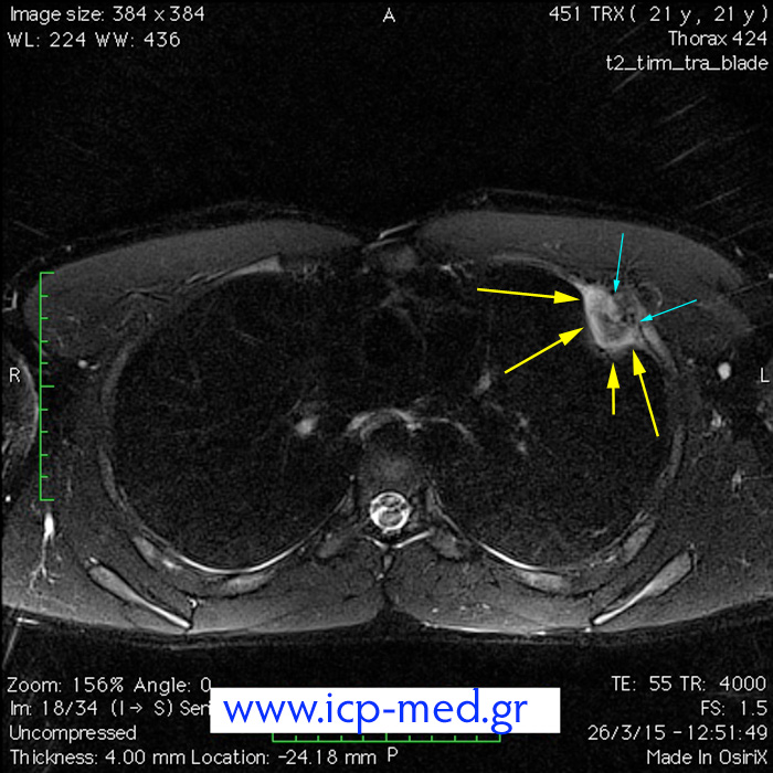 9. Προεγχ. MRI (αξονική τομή· γαλάζια βέλη: σχέση Όγκου με 3η πλευρά)