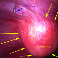 sarcomamyofibrobl10.jpg