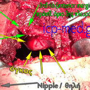 sarcomamyofibrobl11.jpg