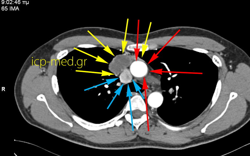 2.CT: το Σεμίνωμα σε Άμεση στενή επαφή με Άνω Κοίλη & Ανιούσα Αορτή