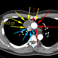 seminoma02.jpg