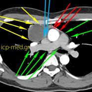 seminoma03.jpg