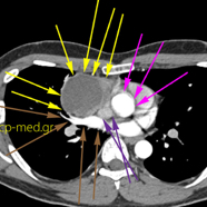 seminoma04.jpg