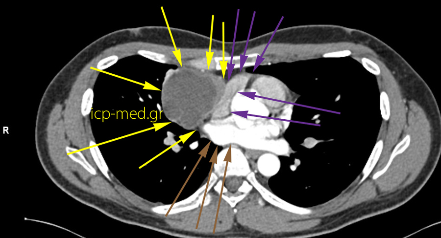 5.CT: Στενή επαφή με Δε Κόλπο (καρδιακή κοιλότητα) & Πνευμονική Φλέβα