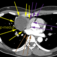 seminoma05.jpg