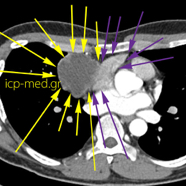 seminoma06.jpg