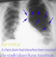 macleodcxr02initialdrain.jpg