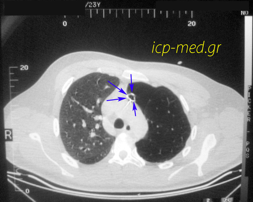 3. CT θώρακος: αγγειακή ερήμωση αριστερά (στένωση της αρ. πνευμονικής αρτηρίας) & Πνευμοθώρακα