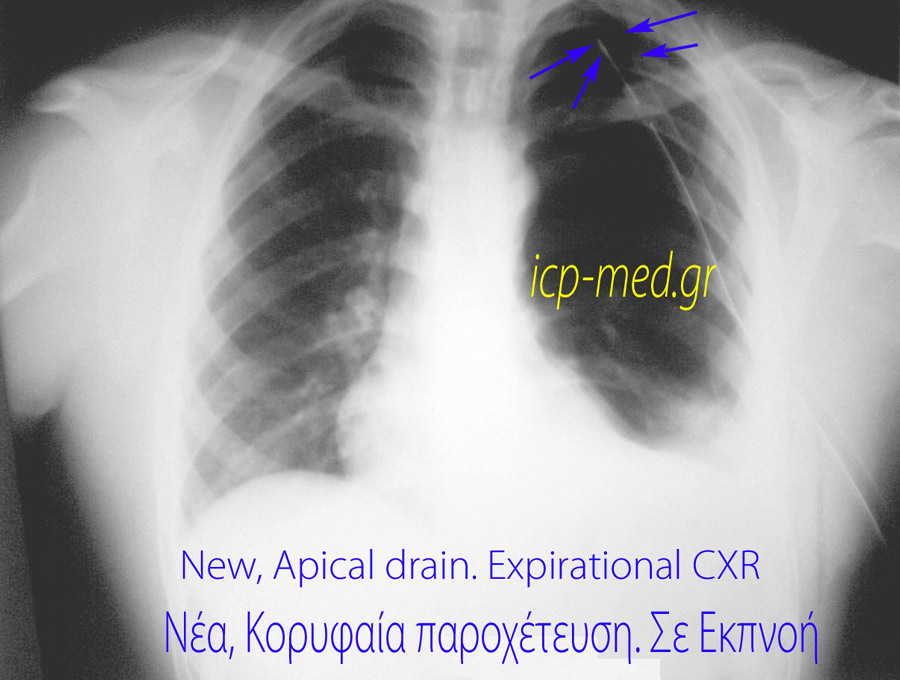 5. Η νέα, Κορυφαία θωρακική παροχέτευση που εισήχθη για αντιμετώπιση του ‘τελικά προκληθέντος’ πνευμοθώρακα
