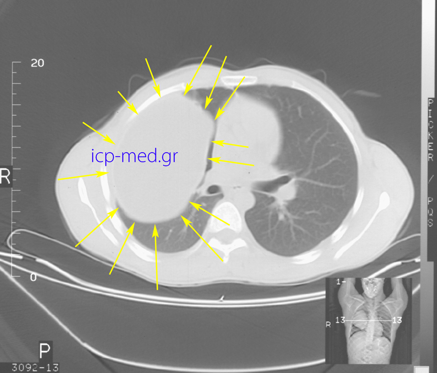 4. Προεχγ/κή CT: Γιγαντιαία Υδατίδα Κύστη (18 x 12 cm, ΚΙΤΡΙΝΑ) ΔΕ πνεύμονος.