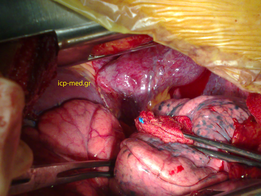 Διεγχερητική φωτογραφία Αγενεσίας Περικαρδίου: διακρίνεται το μυοκάρδιο μετά από απώθηση του αριστερού πνεύμονα με τολύπιο γάζας (αιθάλωση)