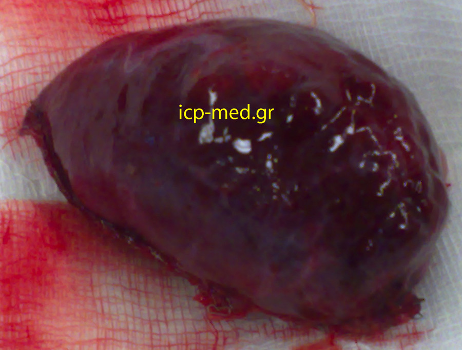 specimen of the bronchogenic cyst resected