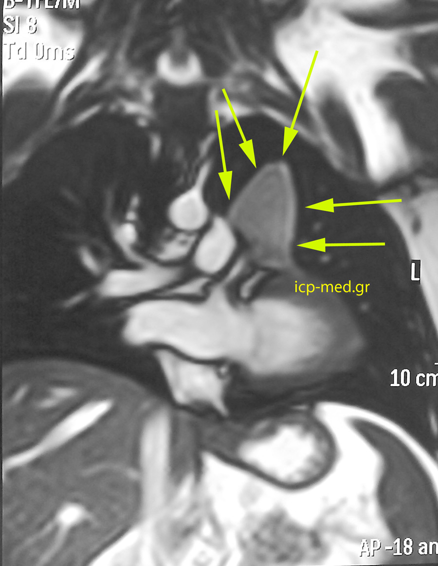 Προεγχειρητική MRI του ασθενούς με Αγενεσία Περικαρδίου: η βρογχογενής κύστη Μεσοθωρακίου καταδεικνύεται από ΚΙΤΡΙΝΑ βέλη.