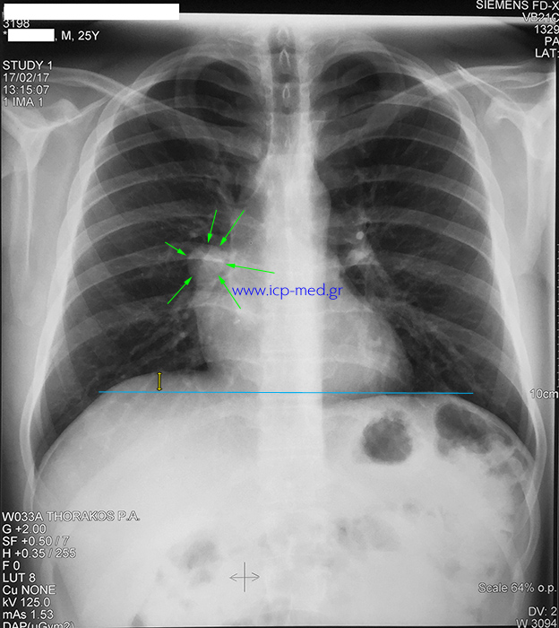 Preoperative CXR of the case mediastinal teratoma