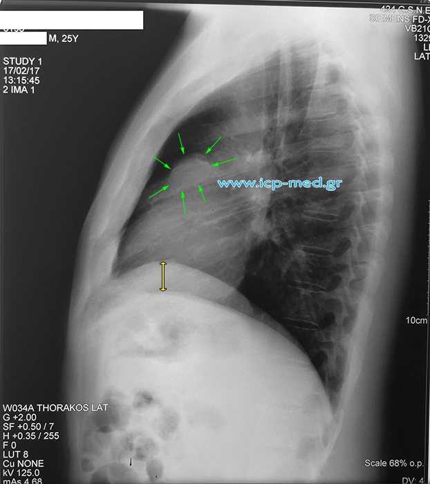 Preoperative lateral CXR of the case mediastinal teratoma