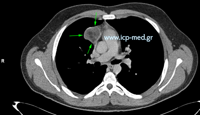 Preoperative CT of mediastinal teratoma