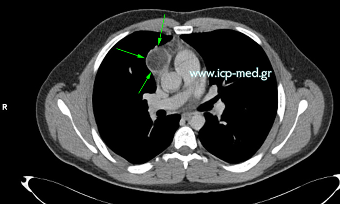 Preoperative CT of mediastinal teratoma