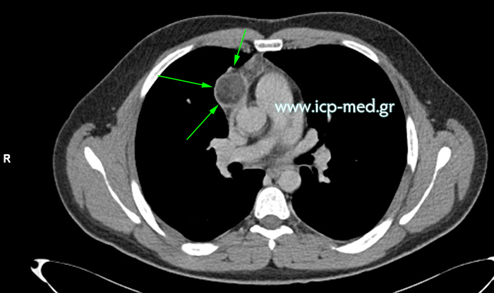 Preoperative CT of mediastinal teratoma