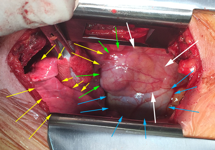 Intraoperative photograph of a mediastinal teratoma