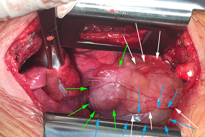 Intraoperative photograph of a mediastinal teratoma