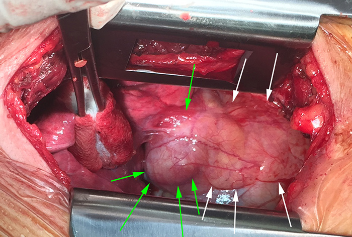 Intraoperative photograph of a mediastinal teratoma