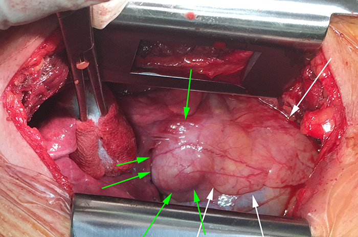 Intraoperative photograph of a mediastinal teratoma