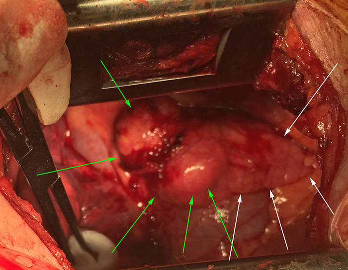 Intraoperative photograph of a mediastinal teratoma